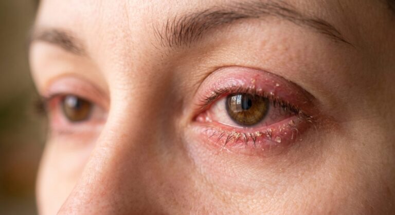Imagem destacada: Close de pálpebra com margens inflamadas discretamente. Alt: "Blefarite — inflamação crônica das margens palpebrais"