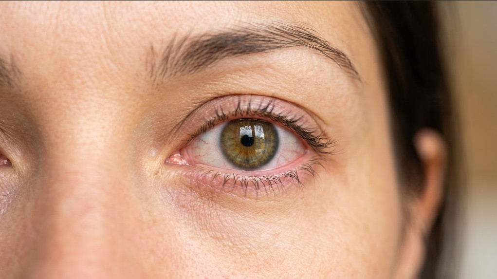 Imagem destacada: Close de olho com leve vermelhidão, ambiente iluminado. Alt: "Conjuntivite — inflamação da conjuntiva ocular pode ter causas diferentes"